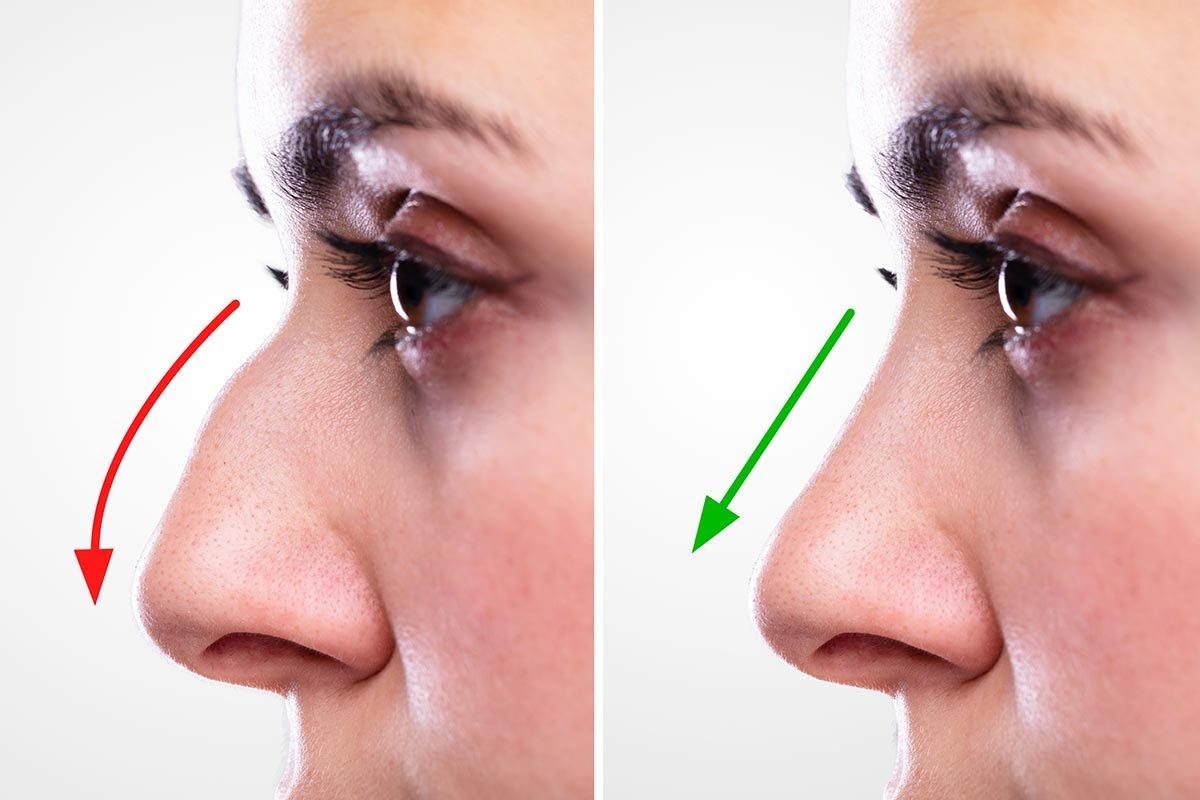 The Risks of Rhinoplasty (Nose Job Surgery)