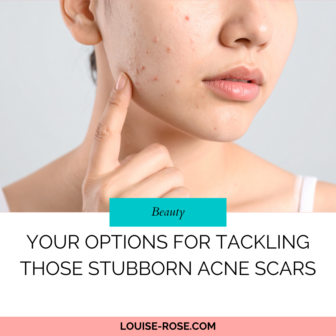 Your Options For Tackling Those Stubborn Acne Scars